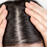 Set for Oily, Greasy Scalp